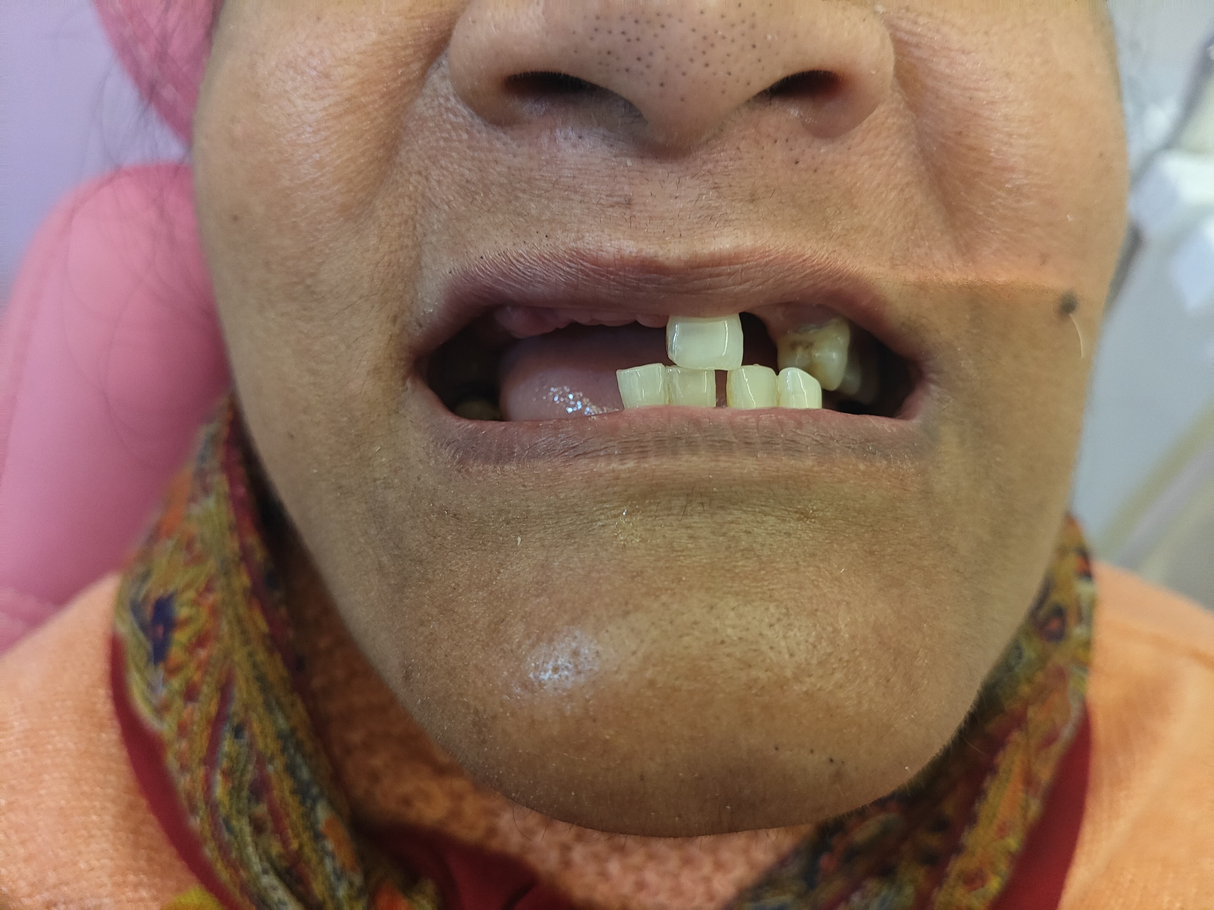 Smile Transformation Case 6